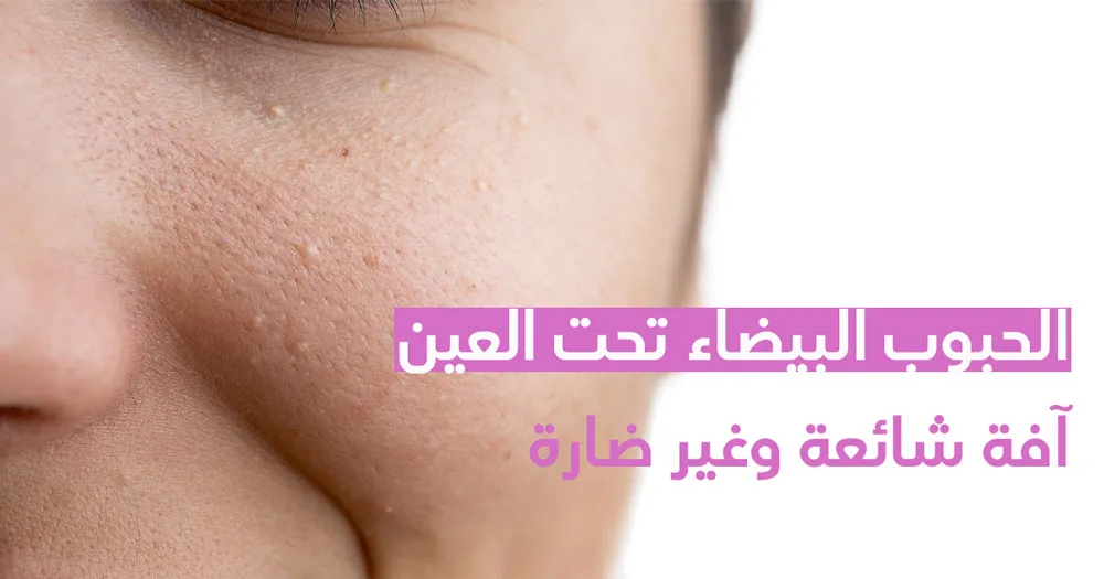 الحبوب البيضاء تحت العين آفة شائعة وغير ضارّة